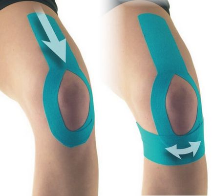 Кінезіотейпірованіе коліна при артрозі або як усунути болі