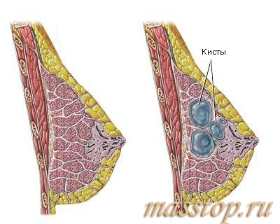 Chistul cauzelor de mastopatie chistică, tratament, diagnostic