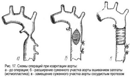 Coarctatio aorta gyermekeknél okoz, jelek, tünetek, kezelés