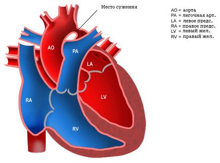 Coarctarea aortei la copii, cauze, semne, simptome, tratament