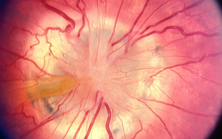 Coliboma nervului optic
