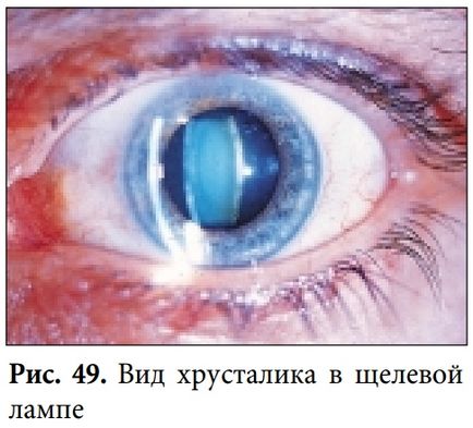 Колобома очі види, причини, симптоми і лікування патології