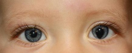 Colobomul tipurilor oculare, cauzele, simptomele și tratamentul patologiei