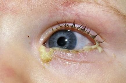 Kötőhártya gyermekek tünetei, kezelése, betegség Photo