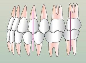 Крива Шпеє в ортодонтії сагиттальная і трансверзального окклюзионная дуга