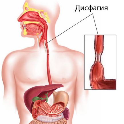 Tratamentul disfagiei - portal medical eurolab