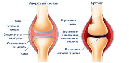 Лікування синовіту колінного суглоба, новий крок