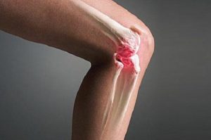 Лікування синовіту колінного суглоба, новий крок