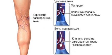 Tratamentul varicozei de floarea-soarelui 2