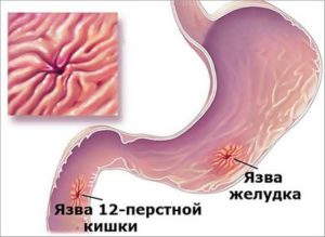 Tratamentul ulcerelor stomacale și duodenale la domiciliu