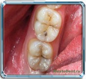 Tratamentul dinților fără foraj și durere - articole pe