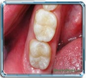 Tratamentul dinților fără foraj și durere - articole pe