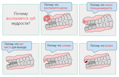 Лікувати або видаляти зуб мудрості рекомендації стоматологів