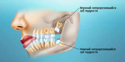 Лікувати або видаляти зуб мудрості рекомендації стоматологів