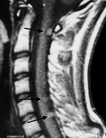 Meningiomul coloanei vertebrale a măduvei spinării lombare și toracice