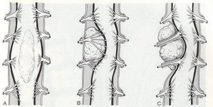 Meningeoma az ágyéki és háti gerincvelő