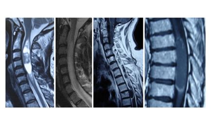 Meningiomul coloanei vertebrale provoacă, simptome, tratament, recuperare de la intervenție chirurgicală