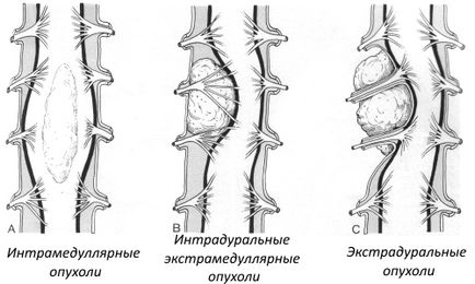 Meningiomul coloanei vertebrale provoacă, simptome, tratament, recuperare de la intervenție chirurgicală