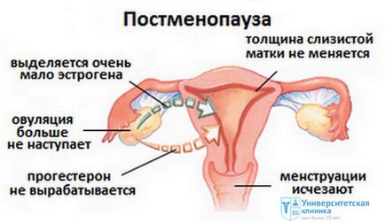 Menopauza prezintă flux - clinica universitară spb