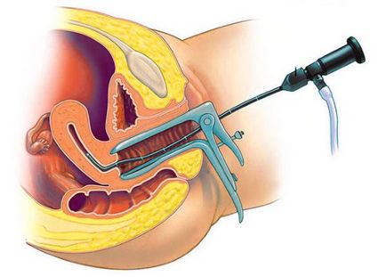 Lunar după histeroscopie când există, abundent, dureros