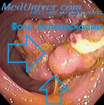 Metoda de polipectomie