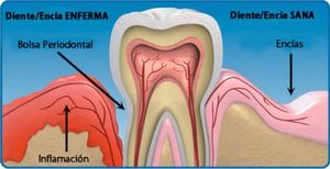 Metode de tratare a buzelor parodontale, caracteristici ale dezvoltării și diagnosticării bolii, sfaturi