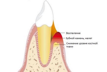 Metode de tratament al parodontitei și prevenirea dezvoltării bolii