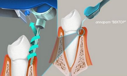 Metode de tratament al parodontitei și prevenirea dezvoltării bolii