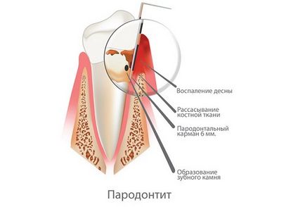 Metode de tratament al parodontitei și prevenirea dezvoltării bolii