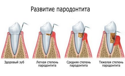 Методи лікування пародонтиту та профілактика розвитку захворювання