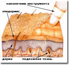 Микродермабразия шкіри обличчя, клініка «мед-арт»