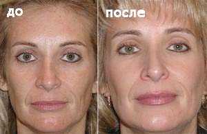 Microdermabraziunea pielii facială, clinica 
