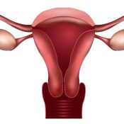 Endometrioza se poate dezvolta in cancer