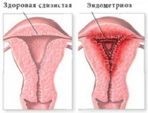 Endometrioza se poate dezvolta in cancer