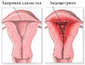 Чи може ендометріоз перерости в рак