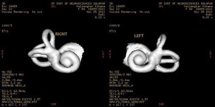 Domnul nervului auditiv, tomografia cu neuroma