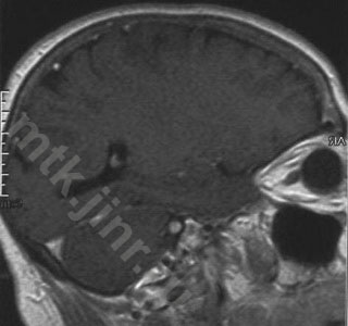 Mtk - neuroma a nervului auditiv