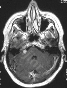 Mtk - neuroma a nervului auditiv