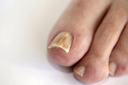 Народний засіб лікування грибка нігтів поради щодо правильного застосування, наталья земна лікування