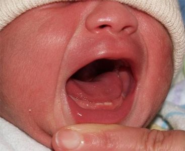 Нежить у немовляти 2-4 місяців ніж лікувати, як зрозуміти що у нього риніт