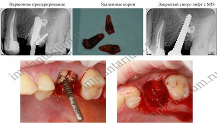 Implantare imediată în domeniul dinților multi-înrădăcinate, implantarium