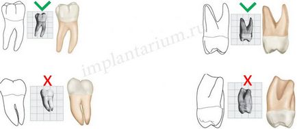 Негайна імплантація в області багатокореневих зубів, імплантаріум