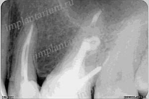 Implantare imediată în domeniul dinților multi-înrădăcinate, implantarium
