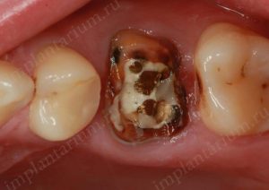 Негайна імплантація в області багатокореневих зубів, імплантаріум