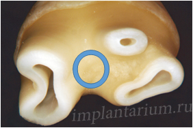 Implantare imediată în domeniul dinților multi-înrădăcinate, implantarium