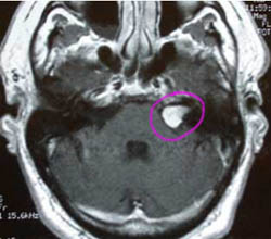 Akusztikus neurinoma kezelés, okai és tünetei