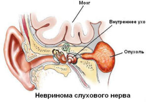 Neurinomul tratamentului, cauzelor și simptomelor nervului auditiv
