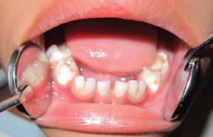 Чи потрібно лікувати молочні зуби, болять вони у дітей, як позбутися від карієсу