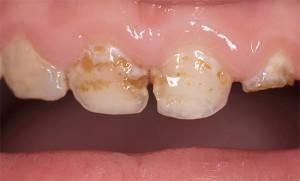 Чи потрібно лікувати молочні зуби, болять вони у дітей, як позбутися від карієсу