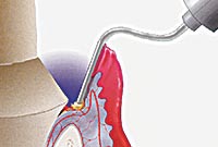 Asigurarea hemostazei și controlul fluidului gingival - stamil depot dentar
